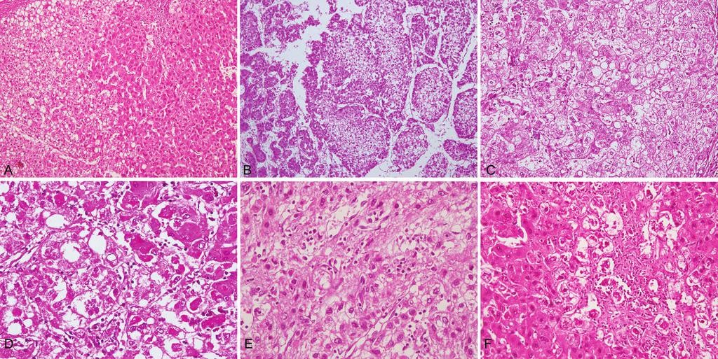 Figure 1. A, Photomicrograph shows well-demarcated areas of steatohepatitic hepatocellular carcinoma (SH-HCC) (left side) in an otherwise welldifferentiated trabecular HCC (right side).