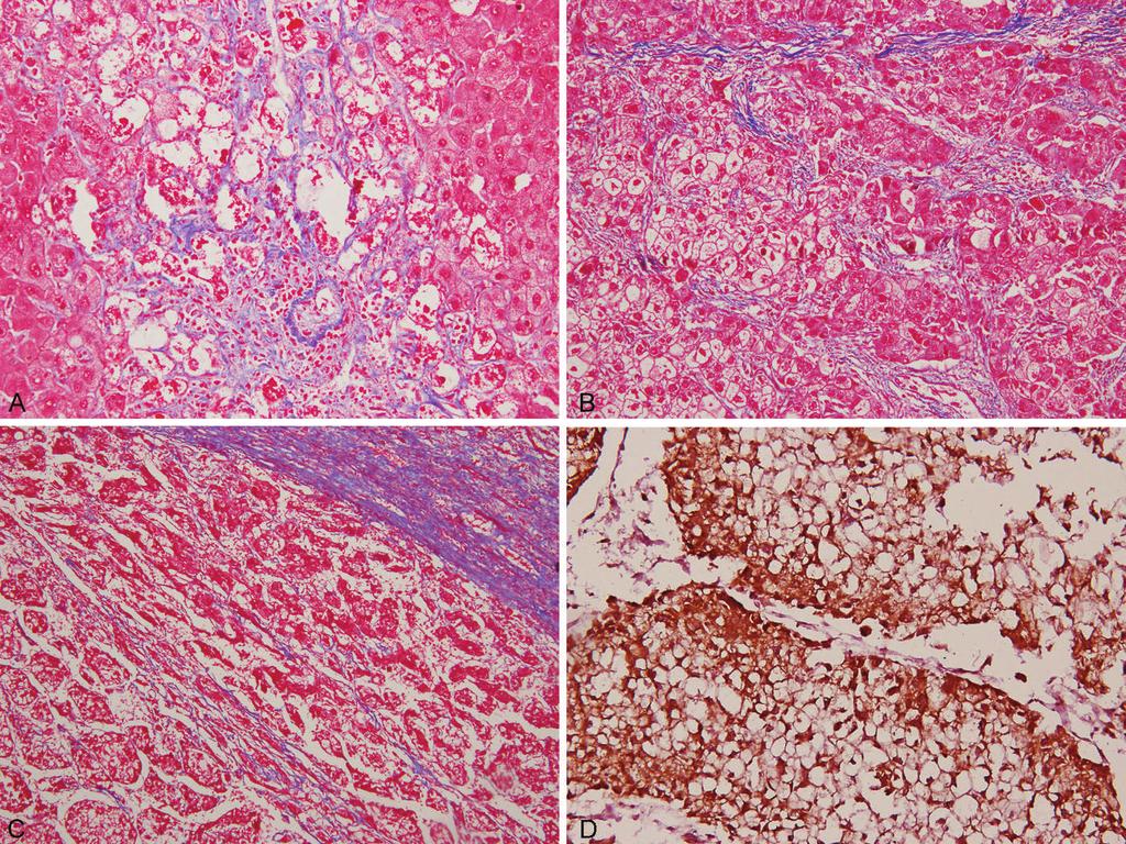Figure 2. A through C, Photomicrographs of steatohepatitic hepatocellular carcinoma (SH-HCC). Fibrosis is better appreciated in Masson trichrome stain.