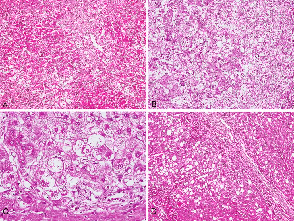 Figure 3. A through C, Case of nonalcoholic fatty liver disease (NAFLD) with steatohepatitic hepatocellular carcinoma (SH-HCC).