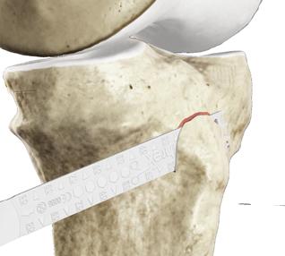 Surgical Technique 1 After reflecting back the superficial portion of the medial collateral ligament, the first breakaway osteotomy guide