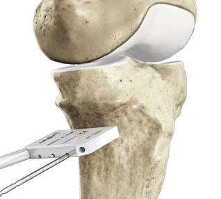 3 4 An oscillating saw is used to create a biplanar osteotomy cut for higher stability and faster healing.