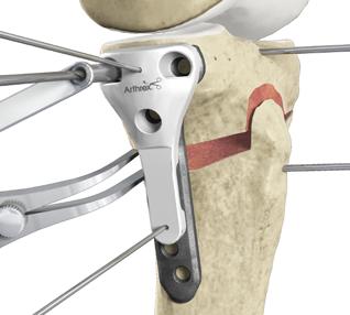 6 Insert the wedge trial into the osteotomy gap to verify the amount of correction.