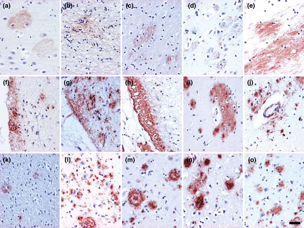 314 Acta Neuropathol (2009) 117:309 320 Fig. 3 Various amyloid-β aggregates i.e. plaques, seen here in brown colour.