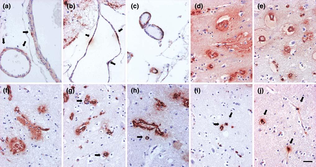 Acta Neuropathol (2009) 117:309 320 315 Fig. 4 Cerebral amyloid angiopathy (CAA). Mild (a, b) and moderate (c) involvement of leptomeningeal arteries and veins.