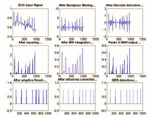The signals chosen were from the MIT/BIH Arrhythmia Database, a set of publicly available twolead ECG records (11-bit data, sampling rate = 360 sps, 30 minutes each) that have been annotated by