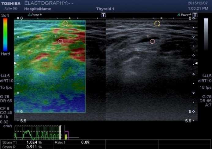 Conclusion Finally, the study concluded that Sonoelastography can improve the performance of conventional sonography in the diagnosis of enlarged cervical lymph nodes by increasing the overall