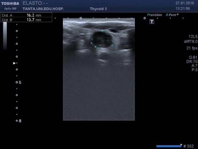 Sonoelastography is a rich and rapidly developing technique that promises to improve diagnosis of many different lymph node diseases.