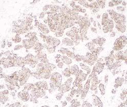 B, Intense, circumferential tumor cell membrane staining seen using a 10 objective (positive) (original magnification 100).