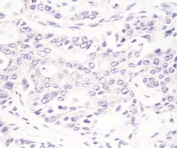 A final subtracted score of 2 or more or tumor cell staining of 3+ or greater was required to categorize a case as HER- 2/neu positive. All slides at PPL were reviewed by 1 pathologist (A.M.G.).