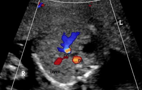 An update on technique of fetal echocardiography with emphasis on anomalies detectable in four chambered view. Dr. Ranjitha.