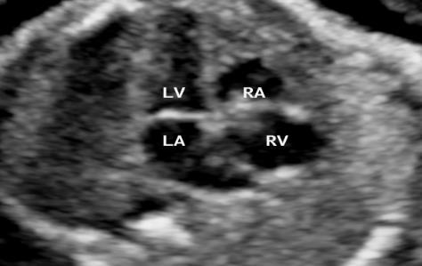 The atrioventricular plane and the posterior atrial walls are better assesed on the apical 4-chamber view, whereas the septa, the myocardial walls and the chordae tendinae are better displayed on the