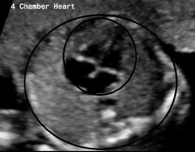 Assignment of the cardiac chambers: the cardiac chamber in front of the spine/ descending aorta is the left atrium, while the chamber located just below the sternum is the right ventricle.