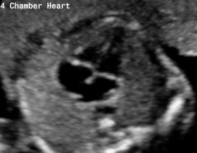 The following are the checklist 1) A normal heart is approximately 1/3 of thorax in size. 2) Two third of the heart is in the left hemithorax.