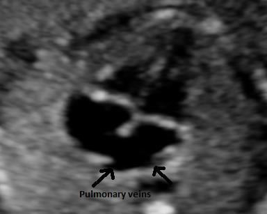 Pulsed wave doppler waveform across the tricuspid valve demonstrating E and A waves corresponding to early ventricular filling and active