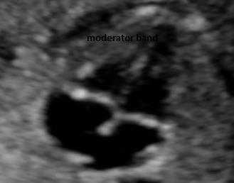 Figure 14: Free myocardial walls are of similar thickness. Figure 15: Interventricular septum is intact.
