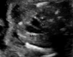 The pulmonary artery is the largest in size, followed by ascending aorta and SVC. The thymus is also clearly visible in this view.