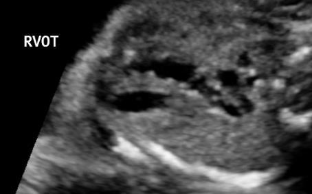 To obtain this view, from the 4-chamber view, the transducer should perform a rotation mirroring that needed for the long axis of the left ventricle, i.e., towards the left fetal shoulder Checklist: 1.