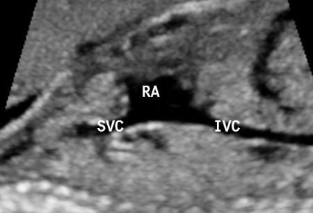 The presence of a semilunar valve showing normal systolic-diastolic excursion (the leaflets disappear completely during systole, flattening on the pulmonary artery walls). 3.