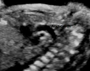 Aortic arch view (sagittal) By rotating the transducer 90 degree either clockwise or counter-clockwise from the 3VV, a candy cane-like aortic arch is seen.
