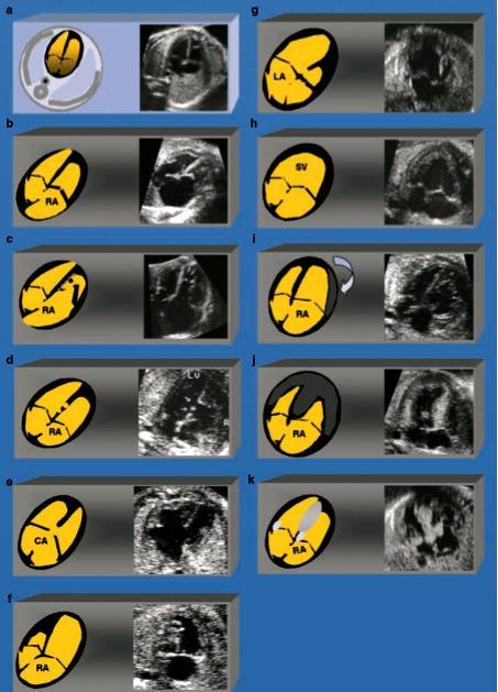 Anomalies recognizable in 4 chamber view Anomalies recognisable in 4-chamber view. Figure a. Normal heart. Figure b. Right atriomegaly from tricuspid dysplasia & insufficiency. Figure c.