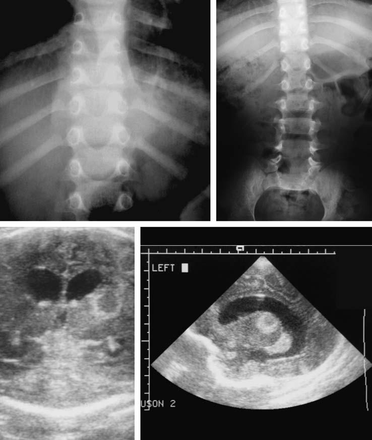 282 Appendix 2: Answers to Questions c Fig. 8.25. Multiple ptients A 2-yer-old with ck pin. This is tuerculosis Pott s disese. Note the disc spce nrrowing of T10 12.
