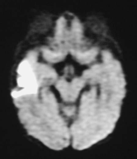It is fluid collection clled syrinx. It thins the neurl tissues Fig. 8.30. One-month-old y with encephlopthy.