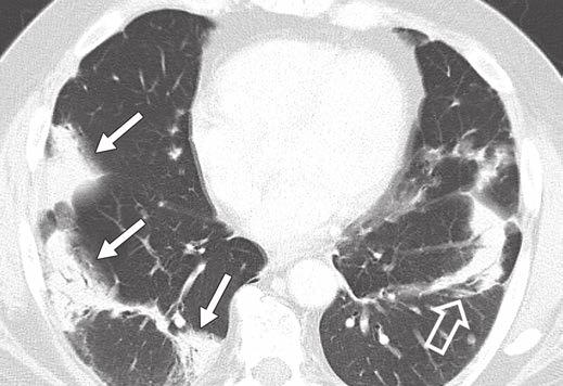 2 Acute eosinophilic pneumonia in 85-year-old man with acute respiratory failure and high percentage of eosinophils on bronchoalveolar lavage.