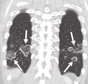 Noninfectious Inflammatory Lung Disease Fig. 5 Reversed-halo sign ( atoll sign) in cryptogenic organizing pneumonia.