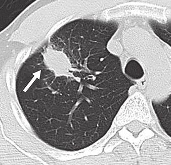 surrounded by denser opacity (arrows) in lower lung. A Fig.