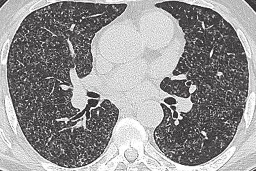 A, 55-year-old female smoker with moderate dyspnea.