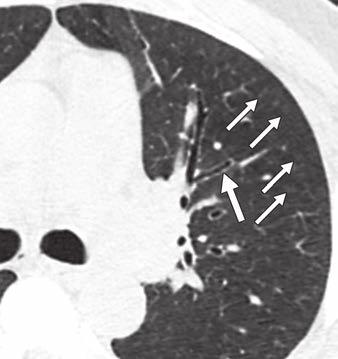 arrow) in upper lobes. B, 67-year-old male smoker with severe dyspnea.