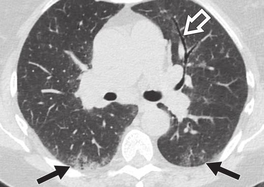 Nemec et al. Fig. 9 Desquamative interstitial pneumonia in 51-year-old female heavy smoker with chronic cough.