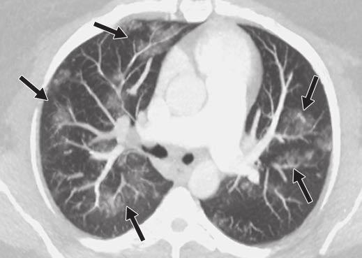 Transverse CT image of chest shows multifocal airspace opacities (arrows) with bilateral perivascular distribution, without consolidations or