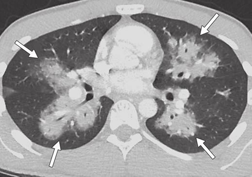 Transverse CT image of chest shows multiple ill-defined nodular lesions (arrows), some of which are situated