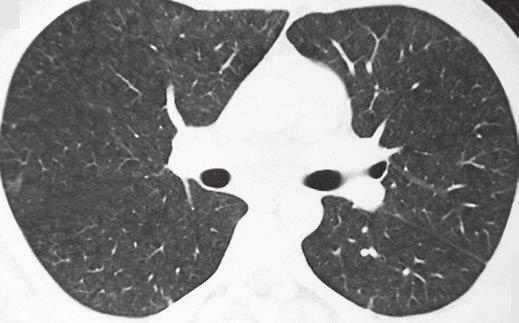 Transverse CT image of chest shows bilateral consolidations (arrows), some with ground-glass halo, along segmental