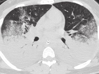17 Idiopathic acute interstitial pneumonia in 50-year-old woman with acute respiratory distress.