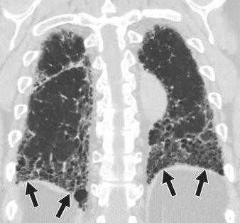 19 Idiopathic usual interstitial pneumonia in 79-year-old man with progressively severe dyspnea over 12