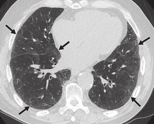 A, Transverse CT image of chest shows subpleural reticular changes with prominent honeycombing (arrows) and