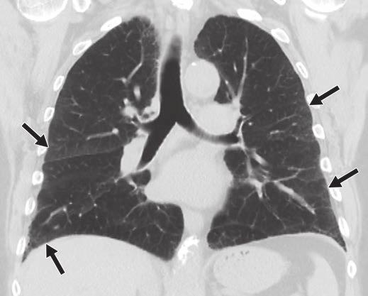 B, Coronal CT image of chest shows obvious apicobasilar gradient of fibrotic changes (arrows), which