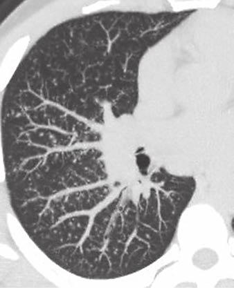Transverse CT image of chest shows bilateral diffuse ground-glass opacities and subpleural reticular opacities with traction