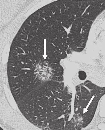 C, 60-year-old woman. Transverse CT image of chest shows bilateral large masslike consolidations (arrows) but no micronodules. D, 40-year-old man.
