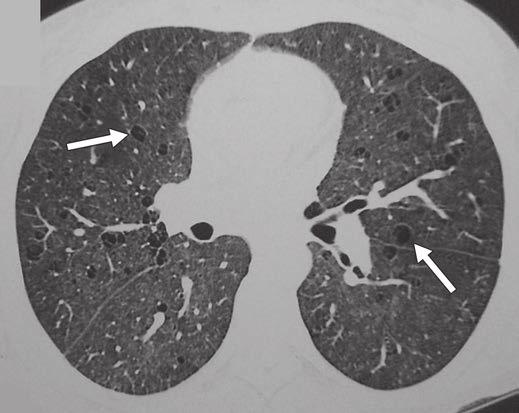 24 Lymphocytic interstitial pneumonia secondary to Sjögren syndrome in 44-year-old woman with mild dyspnea.