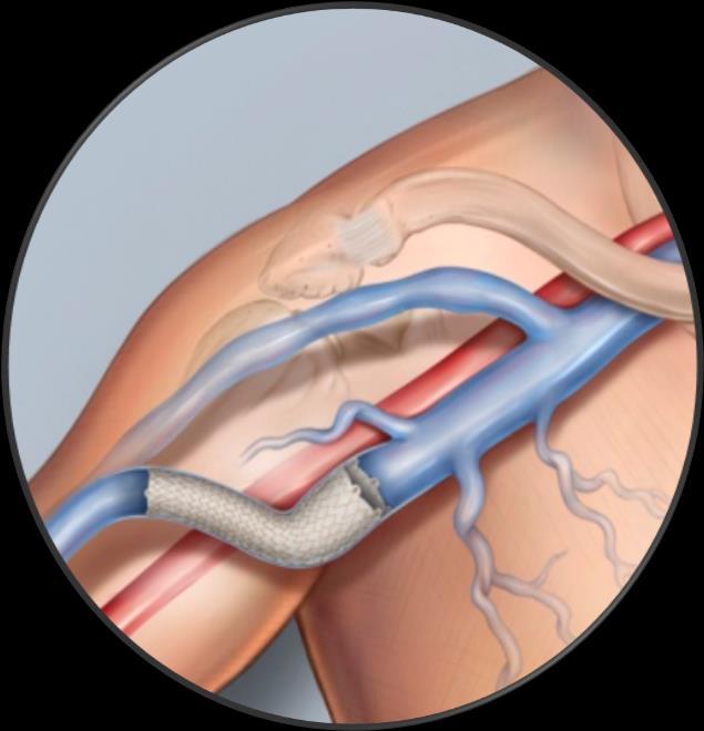 arterio-venous (AV) access graft