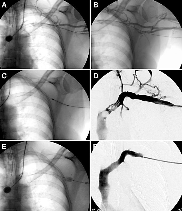 J ENDOVASC THER AXILLOSUBCLAVIAN DVT 735 Figure 1(A, B) In the initial pretreatment venograms, the brachial, axillary and subclavian veins were occluded, with minimal collateral veins.