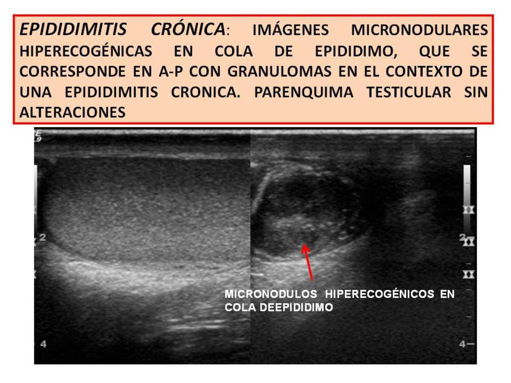 Fig. 2: CHRONIC EPIDIDYMITIS: Micronodular images hyperechogenic in the