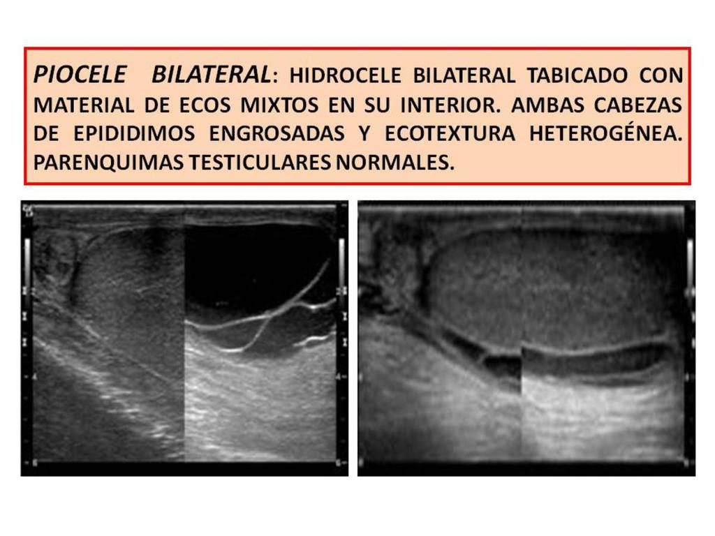 Fig. 4: BILATERAL PYOCELE: Bilateral loculated hydrocele with heterogeneous echoes inside.