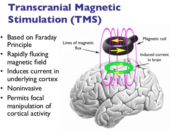 The Restore Study (rtms) Brain Stimulation repetitive Transcranial Magnetic Stimulation To learn whether rtms would improve apathy in people with Parkinson s PD