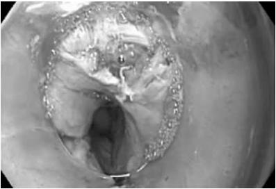 At least 2cm distal to mucosotomy Extend 2cm onto the gastric