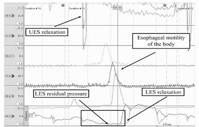 Esophageal Manometry Normal Manometry Used to assess esophageal motility and LES function (pressure, length,