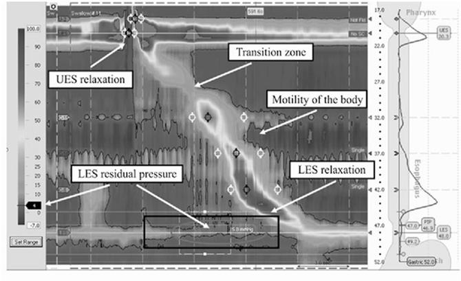 pressure at various points along the esophagus during bolus swallow Normal High-Res Manometry Manometry in